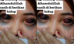 Hijaber Cantik Jadi Korban Tragedi Kanjuruhan, ada Luka Dibagian Mata