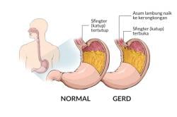 Mengenal Gejala dan Cara Pencegahan GERD atau Asam Lambung