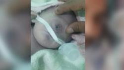 Bayi Bermata Satu Telah Dilahirkan, Apakah ini Sebuah Pertanda