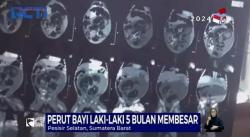 Fenomena Bayi Lelaki Berusia 5 Bulan Hamil Heboh di Medsos, Ternyata Janin Kembarannya