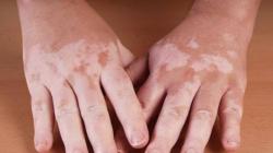 Panduan Terlengkap Mengenai Vitiligo: Penyebab, Gejala, dan Pilihan Terapi