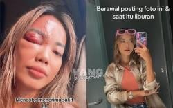 Penyakit Ain Tatapan Mata Disertai Rasa Dengki, Wanita Cantik Ini Matanya Bengkak Seperti Kena Tinju