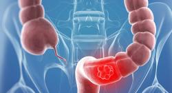 Kanker Kolon dan Rectum, Yuk Simak Cara Deteksi Dini dan Pencegahannya