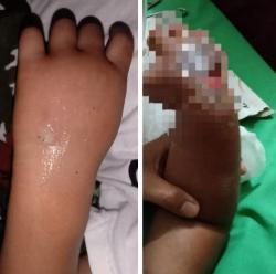 Dua Anak Balita Alami Luka Pasca Rawat Inap di Puskesmas