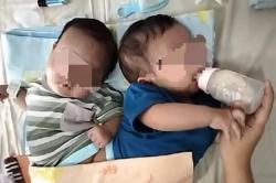 RSUD dr Iskak Tulungagung Terus Pantau  Perkembangan Bayi Kembar Siam