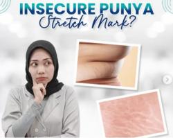 Stretch Mark: Kondisi Kulit Umum yang Dapat Mempengaruhi Kepercayaan Diri dan Kesehatan Mental