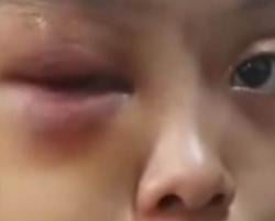 Kejam, Tante di Kampar Aniya Ponakan yang Yatim degan Rotan dan Dinjak Hanya Hal Sepele