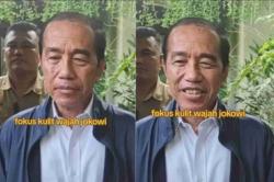 Jokowi Diduga Mengidap Sindrom Stevens Johnson, Apa Itu SJS?