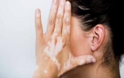 Bulan Vitiligo Dunia, C Derma Kampanyekan Kelainan Pigmentasi Kulit