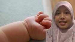 Dokter Alumni UI Tanggapi Dugaan Malapraktik Amputasi Tangan Balita di Bima: Sindrom Kompartemen
