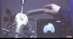 Bedah Lutut Kronis Makin Canggih, Alat Asal Korea Selatan Ini Mampu Deteksi Penyakit Lebih Detail