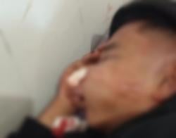 Diduga Dianiaya Polisi, Pemuda di Ruteng NTT Terkapar di Rumah Sakit dengan Wajah Lebam