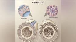 Cegah Osteoporosis Sejak Dini, RSUD Subang Bagikan 5 Tips Jaga Kesehatan Tulang
