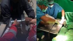 Luput Pengawasan, Tangan Bocah 3 Tahun Tersangkut Mesin Penggiling Daging di Makassar