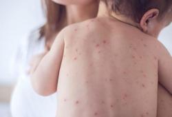 Gawat! 31 Anak Cilegon Terkena Campak Rubella Sejak September 2025