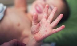 Waspada! 66 Balita di Tangsel Kena Campak Rubela Parah