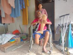 Mimpi Thonari Dapat Bantuan Kaki Palsu Kini Terwujud, Semangat Hidup Kembali