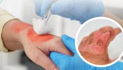 Banyak Warga Masih Keliru, RSUD Pandega Rilis Panduan Penting Pertolongan Luka Bakar