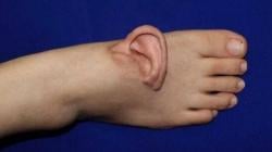 Aneh tapi Nyata! Telinga Perempuan Ini Ada di Kaki Pascaoperasi Kecelakaan Kerja