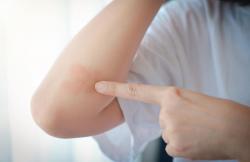 Lupus Banyak Menyerang Perempuan Usia Produktif, Ini Penjelasan Dokter