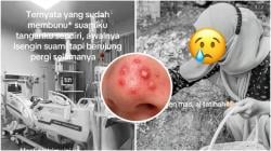 Kisah Pilu dan Tragis Istri Pencet Jerawat Suami Berujung Meninggal Dunia, Berawal dari Candaan