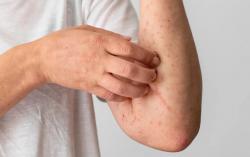 Kasus Campak di Kota Tangerang Meledak, Kenali Gejalanya Sebelum Terlambat