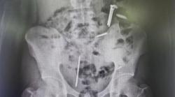 Fenomena Pica? Remaja Jember Telan Paku dan Koin, Ini Penjelasan Petugas