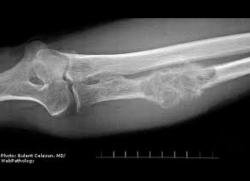 Kanker Tulang Mengintai Diam-Diam, Warga Pangandaran Diingatkan Jangan Abaikan Nyeri Sekecil Apa Pun