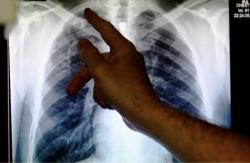 Waspada! Gejala Sepele Ini Bisa Jadi Awal Tuberkulosis Mematikan
