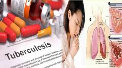 Angka Penyakit TB Masih Tinggi di Indonesia! Karena Banyak Masyarakat yang Masih Anggap Sepele