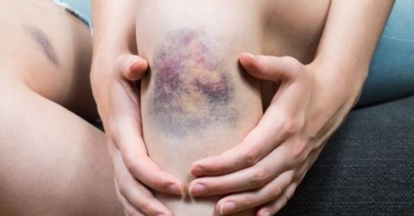 Gelaja Diabetes Pada Wanita, Luka dan Memar 