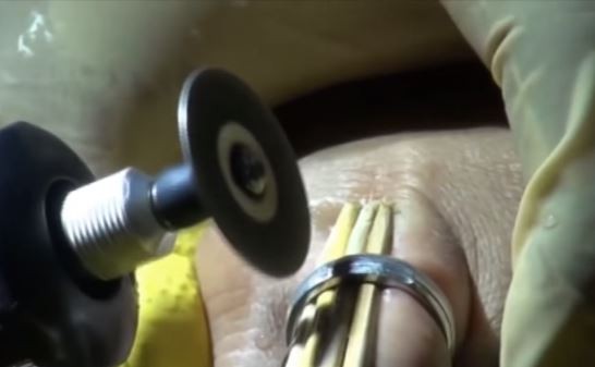 Iseng Pakai Cincin Baut Ring, Jari Tangan Warga Purbalingga Bengkak gegara Tak Bisa Dilepas