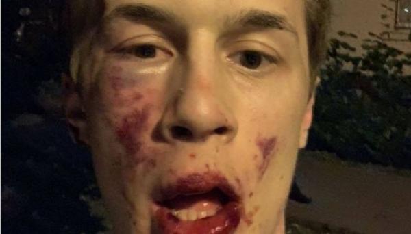 Foto wajah Yegor Zhukov usai dipukuli oleh orang tak dikenal. (foto: BBC)