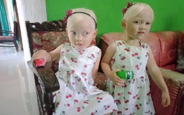 Kembar albino Nadira Nur Ainiyah dan Nadia Nur Azahra, anak kembar yang mengindap Albino di rumahnya, Dusun Gadungan RT 001/RW 003, Desa Nambangan, Kacamatan Selogiri, Wonogiri, Rabu (2/9/2020). (Foto: Solopos/M Aris Munandar)