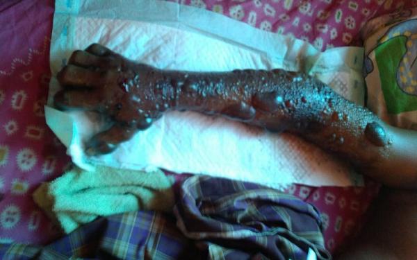 Kondisi tangan Wagiyo setelah digigit ular. (Foto: Istimewa/PMI Sragen)
