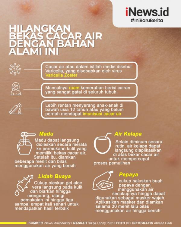 Infografis Cara Menghilangkan Bekas Cacar Air