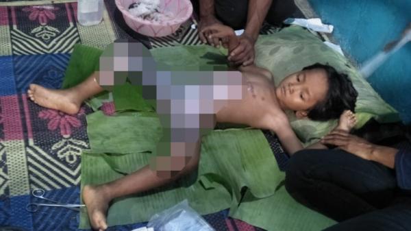 Bocah asal Lampung yang menderita luka bakar dan tak mampu berobat (Jimi Irawan/iNews)