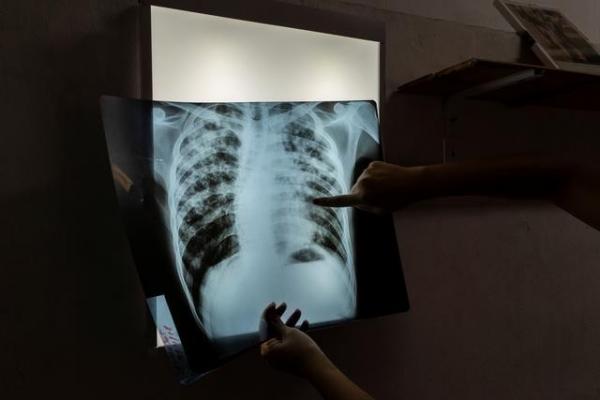 It turns out that this is the reason that Tuberculosis Cases in Indonesia have dropped dramatically during the pandemic