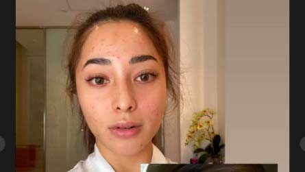 29nikita Willy 0k Nikita Willy memperlihatkan wajahnya yang rusak arena jerawat. (Foto: Instagram/Nikita Willy)