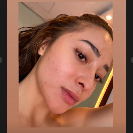 Screen Shot 2021 04 29 At 15 36 47 Nikita Willy membagikan foto wajahnya yang rusak karena jerawat