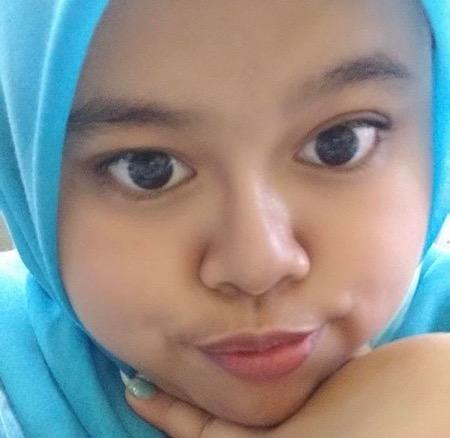 Kekeyi filler Kekeyi setelah filler hidung.