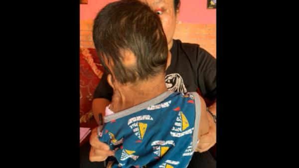 Kondisi anak dan istri yang disiram air keras oleh suaminya di Lampung Tengah (Roy M Perleoli/MNC Portal)