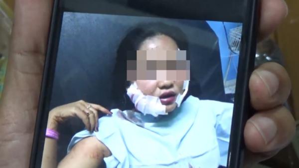 Korban sayatan Korban yang mengalami luka sayatan di wajah akibat ulah pelaku (Budi Sunandar/MNC Portal)