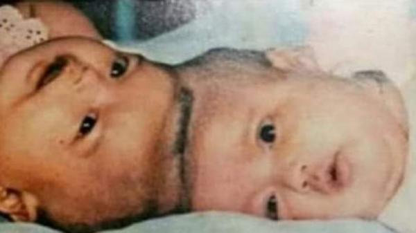 Bayi Kembar Siam Yuliana dan Yuliani, bayi kembar siam yang diselamatkan Profesor Padmo pada tahun 1987 silam (Twitter/@FYudiWibowo4)