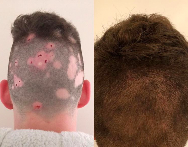 Penyakit teraneh di dunia hingga kini belum ditemukan obat. (Instagram)