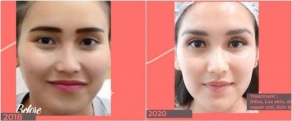 WhatsApp Image 2022 01 06 At 4 23 03 PM Deretan artis ini melakukan perawatan wajah tanam benang. (Foto: Instagram)