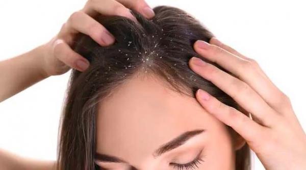 Waspada Jenis-Jenis Ketombe, Ini Penyebab dan Cara Menghilangkannya 