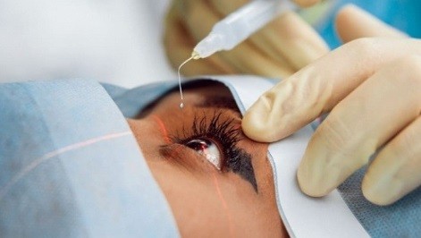 Penglihatan Buram Pasca Operasi Katarak: Apa Saja Faktor Risikonya?