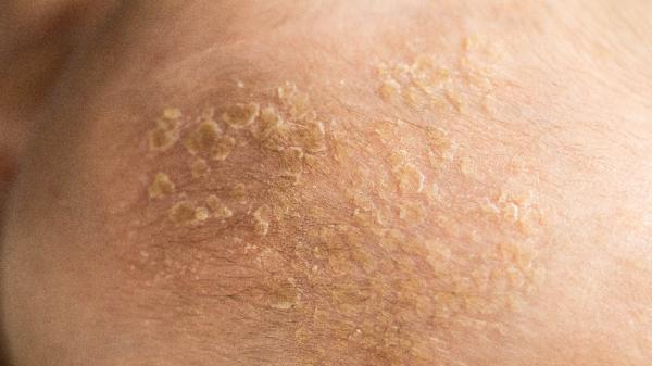 Ini Cara Mengobati Jamur Kulit yang Membandel, Jangan Panik!