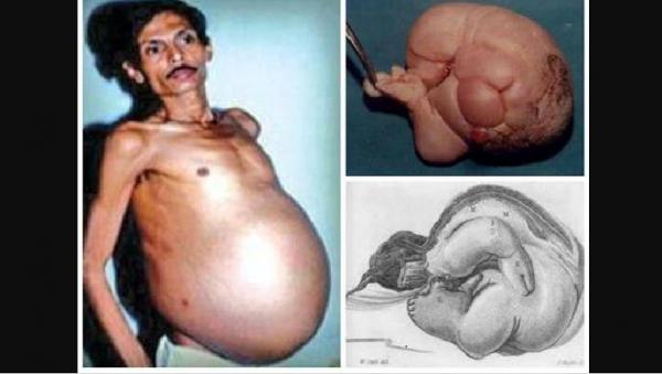 Sanju Bhagat Sanju Bhagat membawa janin saudara kembarnya puluhan tahun. (Foto: Facebook )